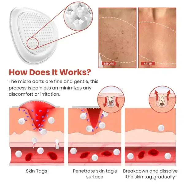 DermaSmooth Skin Tag Remover Patch